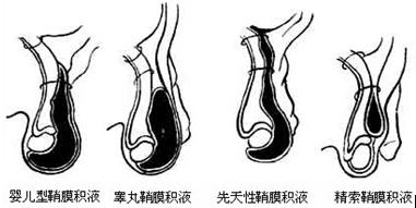 最新技術(shù)——腹腔鏡微創(chuàng)手術(shù)治療睪丸鞘膜積液
